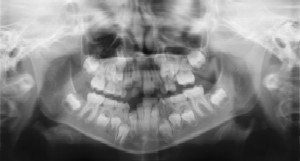 Pediatric Dentist in Fairfield and Oakland, CA- Dental Radiographs (X-Rays)