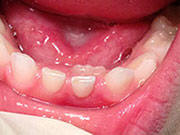 Baby Teeth - Pediatric Dentist in Fairfield and Oakland, CA